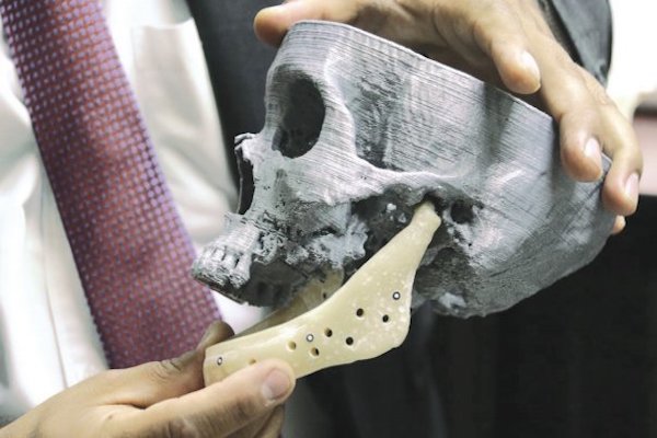 Prótesis de mandíbula. Foto: Especial